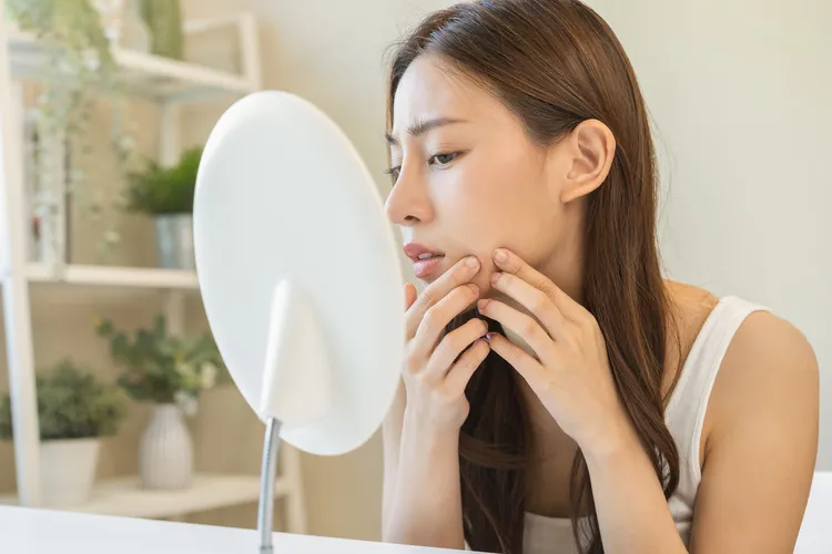 ニキビを潰したい‥潰すことで起こり得るトラブルを医師が解説