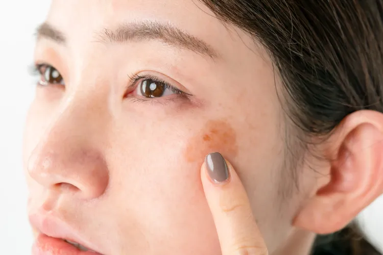 シミは自然に消える？