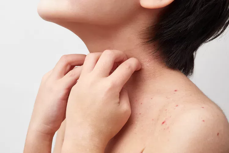 汗かぶれはどんな状態？｜原因・症状・皮膚科での治療について
