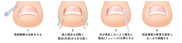 フェノール法