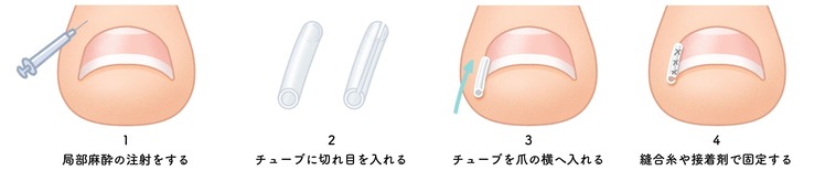 ガター法