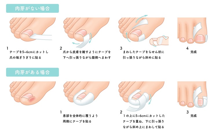 テーピングの手順