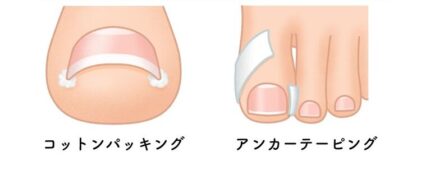 テーピング・コットンパッキング法