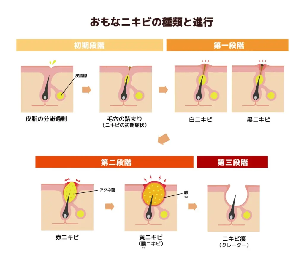 ニキビの進行