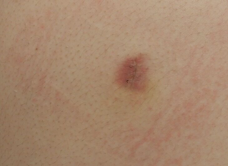 Atheroma01_after