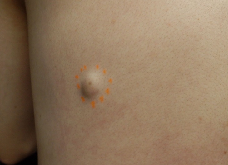 Atheroma01_before