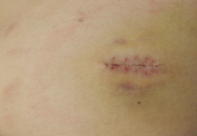 Atheroma02_after