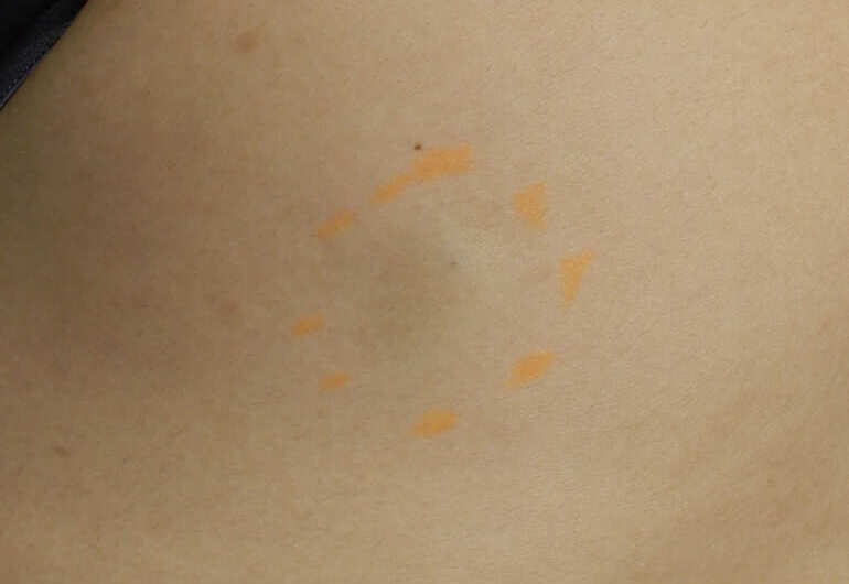 Atheroma02_before