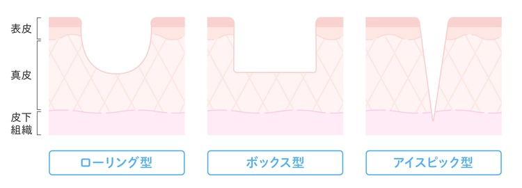 ニキビの凹みの種類