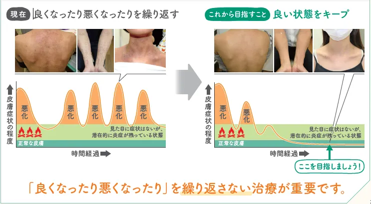 デュピクセントの必要性