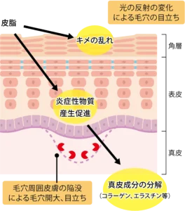 毛穴が目立つ要因
