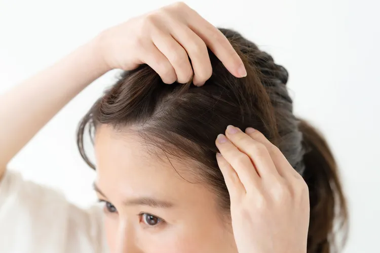 女性の薄毛
